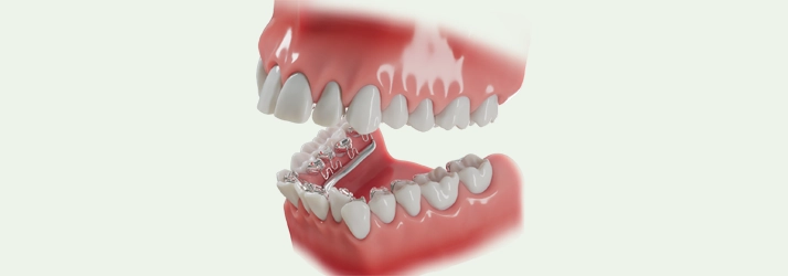 Orthodontist San Diego CA lingual braces
