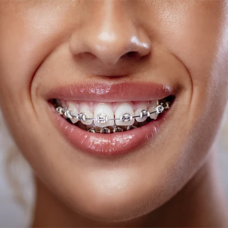 Close-up of a person's mouth showing metal braces on the upper teeth and part of the lower face.